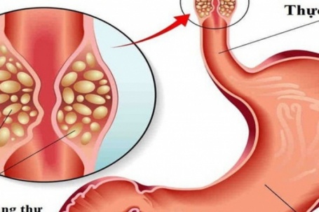 Người đàn ông 50 tuổi phát hiện ung thư dạ dày, tiền ung thư thực quản từ dấu hiệu nhiều người Việt bỏ qua