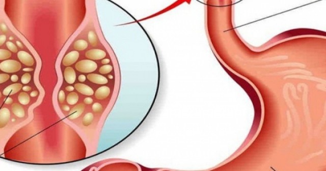 Người đàn ông 50 tuổi phát hiện ung thư dạ dày, tiền ung thư thực quản từ dấu hiệu nhiều người Việt bỏ qua