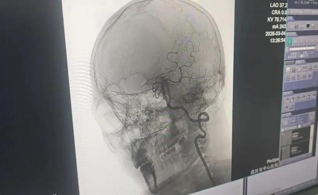 Wang được can thiệp và tái thông thành công mạch máu bị tắc. Ảnh: Trường Giang nhật báo