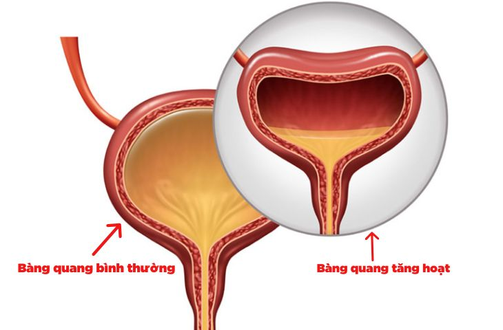 Cảnh báo: Đây mới là “sát thủ giấu mặt” khiến bạn tiểu nhiều, không phải do “thận yếu”! - 2