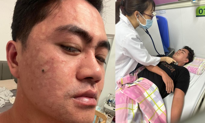 Triệu Cường dị ứng sau khi món đặc sản Cao Bằng. Ảnh: NVCC