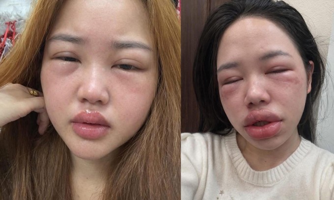 Một số tài khoản đăng hình ảnh gương mặt sưng vù thu hút lượng tương tác lớn.