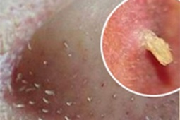 Tin tức sức khỏe - Con trai bị mụn không cần đi spa, thử ngay mẹo này