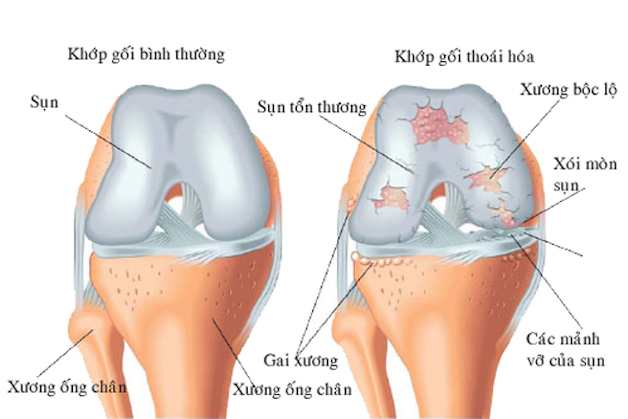 3 yếu tố giúp xương khớp khỏe mạnh trong ngày Sức khỏe Toàn Dân - 4