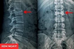 Tin tức sức khỏe - 3 tư thế ngủ tốt nhất giúp giảm đau rõ rệt cho người bị thoái hóa cột sống