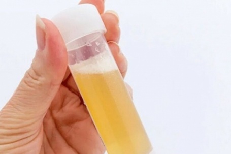 Nước tiểu có bọt như bia cảnh báo thận suy yếu