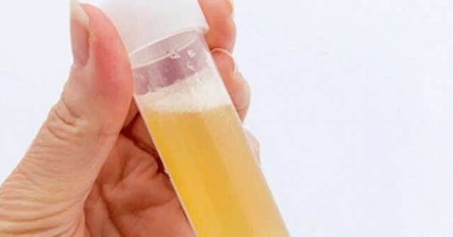 Nước tiểu có bọt như bia cảnh báo thận suy yếu