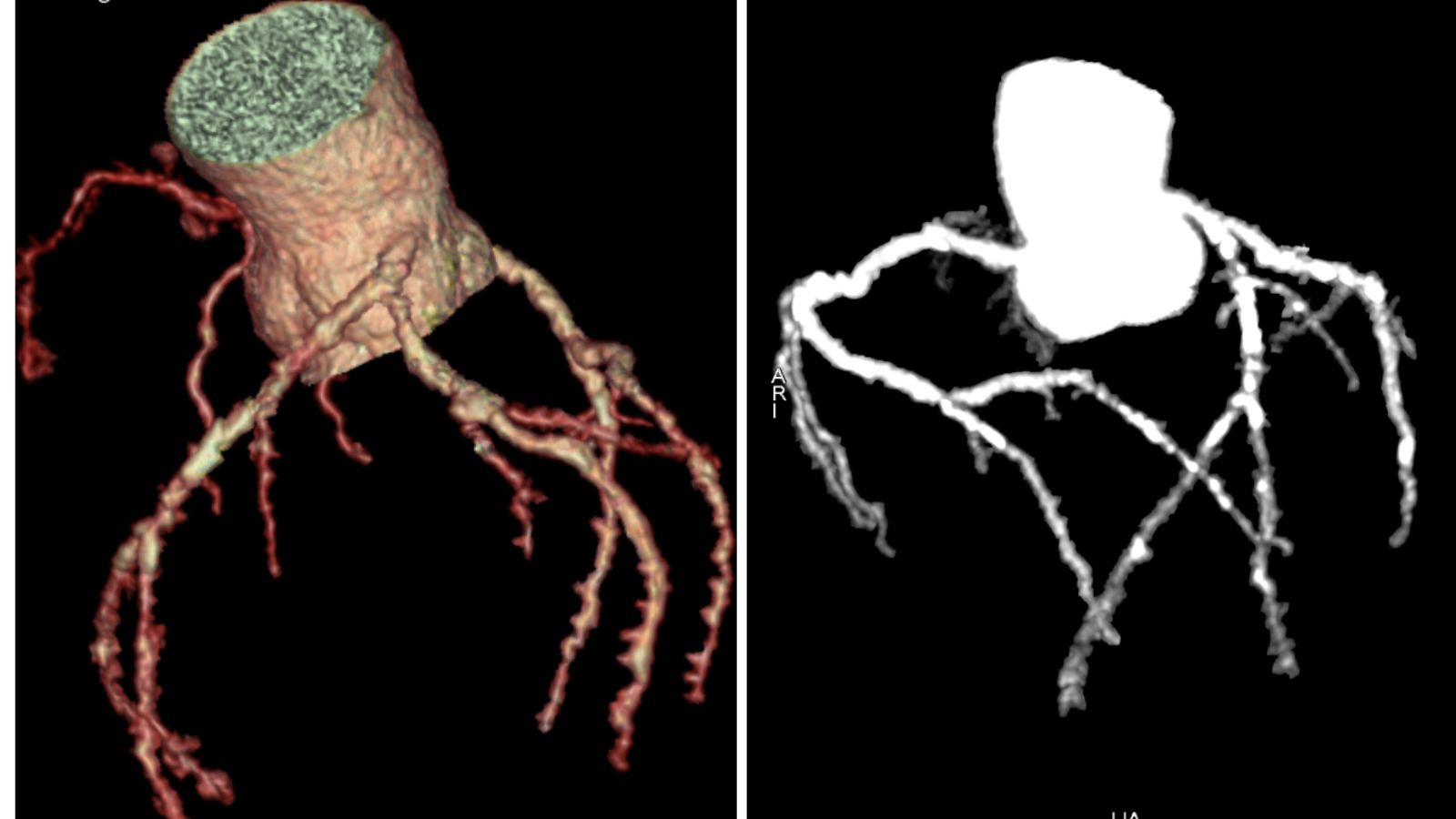Hình ảnh mạch vành hẹp và vôi hoá lan toả