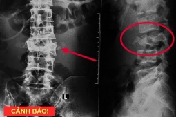 Tin tức sức khỏe - 5 thói quen tàn phá xương khớp cực nhanh, nên bỏ càng sớm càng tốt