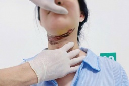 Nữ sinh bị dây điện quấn vào cổ trên đường đi học về