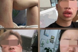 Sưng mắt, môi sau khi ăn bánh trứng kiến: Đặc sản hay 'thủ phạm'?