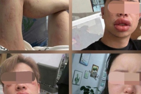 Sưng mắt, môi sau khi ăn bánh trứng kiến: Đặc sản hay 'thủ phạm'?