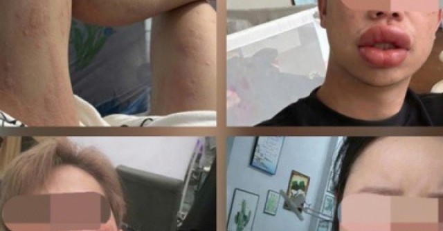 Sưng mắt, môi sau khi ăn bánh trứng kiến: Đặc sản hay "thủ phạm"?