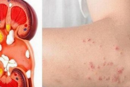 Bất ngờ phát hiện suy thận giai đoạn nặng từ dấu hiệu nhiều người Việt mắc phải nhưng dễ bỏ qua