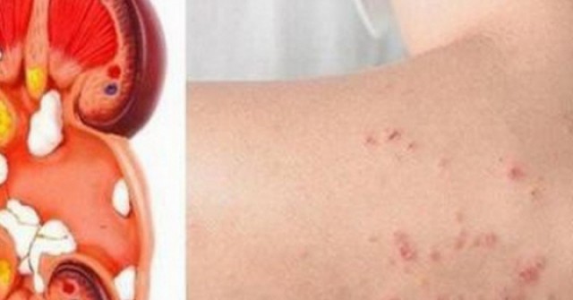 Bất ngờ phát hiện suy thận giai đoạn nặng từ dấu hiệu nhiều người Việt mắc phải nhưng dễ bỏ qua