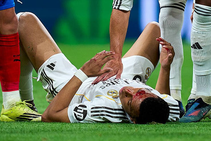 Khuôn mặt dính máu của Mbappe