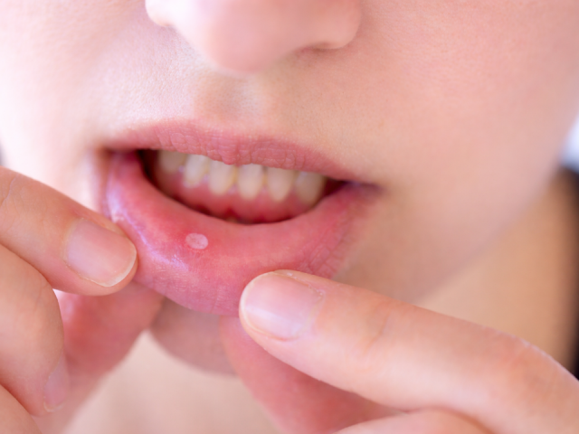 Dấu hiệu cảnh báo ung thư miệng không nên bỏ qua