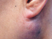 Tê bì, khó nhai nuốt vì khối u bất thường dưới tai