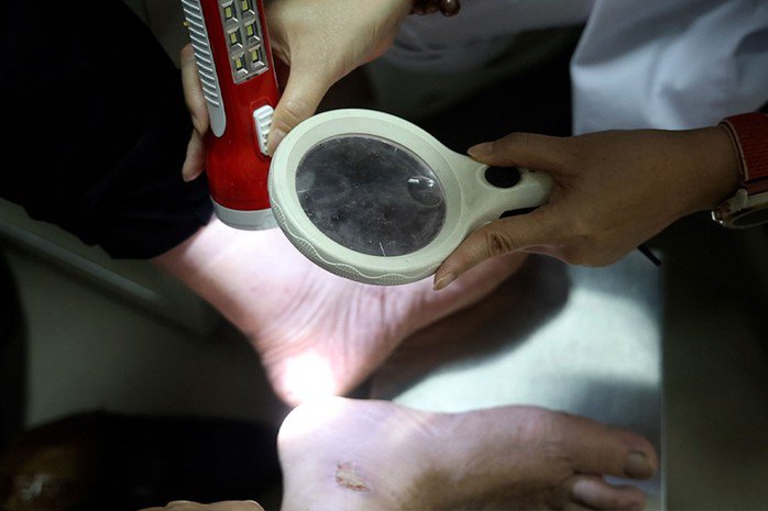 Bệnh nhân bị nấm da chân do đi giày kín trong nắng nóng. Ảnh: Dương Anh