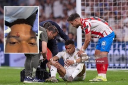 Mbappe khâu 3 mũi, vắng mặt buổi tập của Real: Có lỡ đại chiến Bayern?