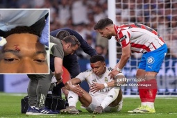 Bóng đá - Mbappe khâu 3 mũi, vắng mặt buổi tập của Real: Có lỡ đại chiến Bayern?