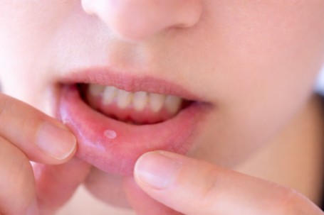 Dấu hiệu cảnh báo ung thư miệng không nên bỏ qua