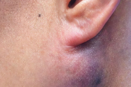 Tê bì, khó nhai nuốt vì khối u bất thường dưới tai