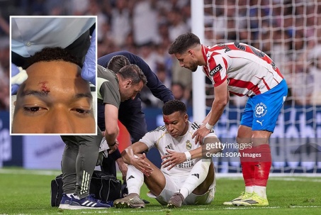 Mbappe khâu 3 mũi, vắng mặt buổi tập của Real: Có lỡ đại chiến Bayern?