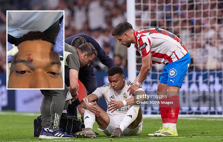 Mbappe khâu 3 mũi, vắng mặt buổi tập của Real: Có lỡ đại chiến Bayern? - 1