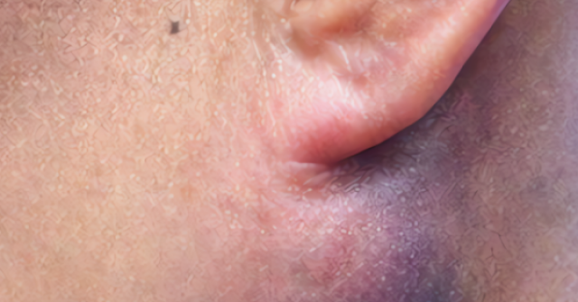 Tê bì, khó nhai nuốt vì khối u bất thường dưới tai