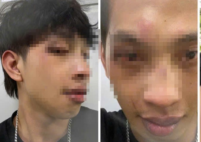 Vụ việc khiến anh P bị thương ở vùng đầu và chảy máu ở tay phải.