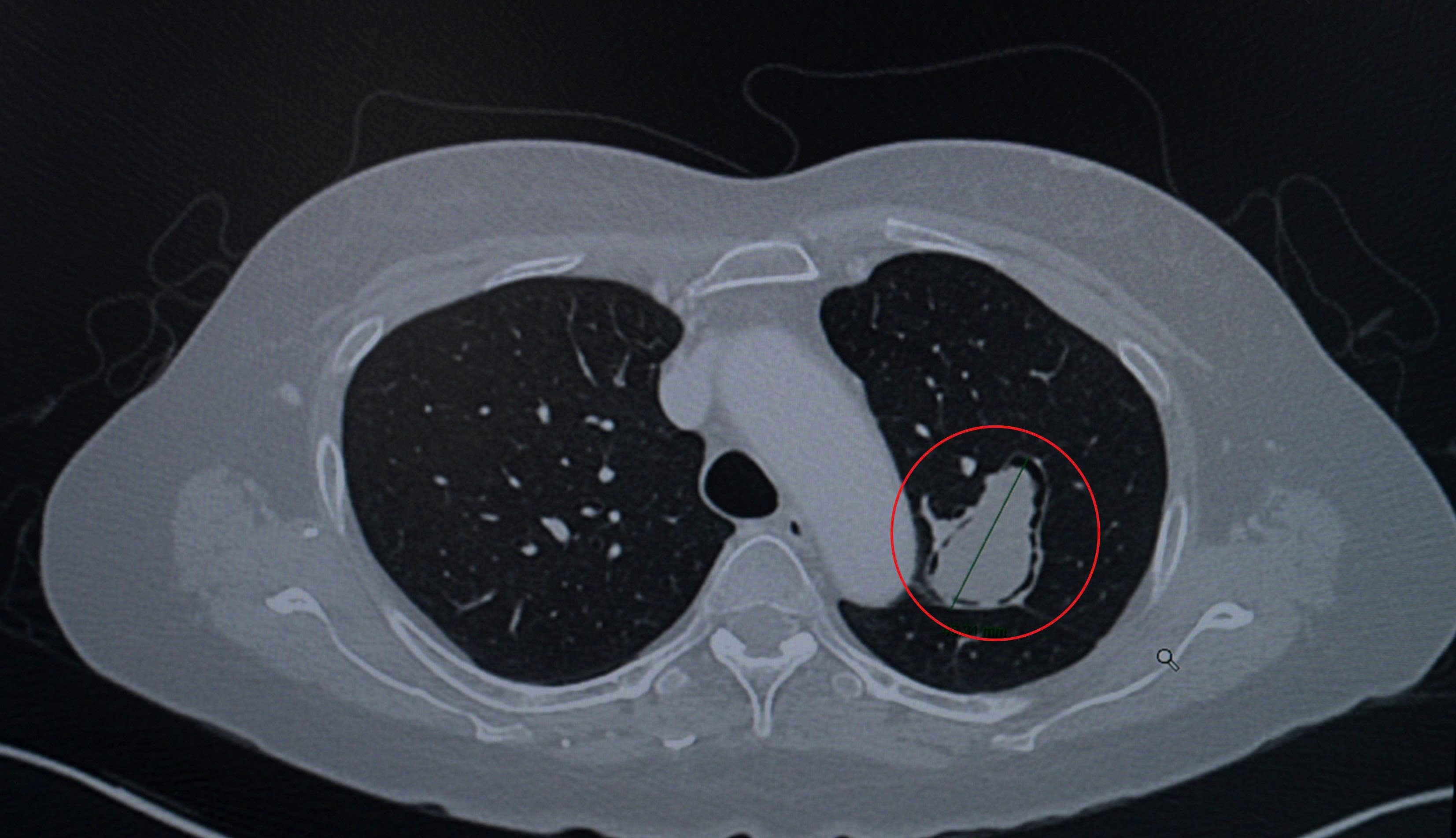 Hình ảnh CT ngực: khối u nấm phổi (khoanh đỏ) nằm ở thùy trên phổi trái, sát đường thở và động mạch chủ ngực, đường kính hơn 4cm. (Ảnh:FV)
