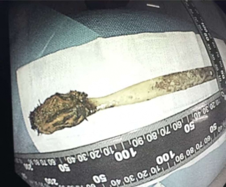 Năm ngoái, một người đàn ông được phẫu thuật lấy ra chiếc bàn chải đánh răng mắc kẹt trong ruột suốt 52 năm. Ảnh: Douyin