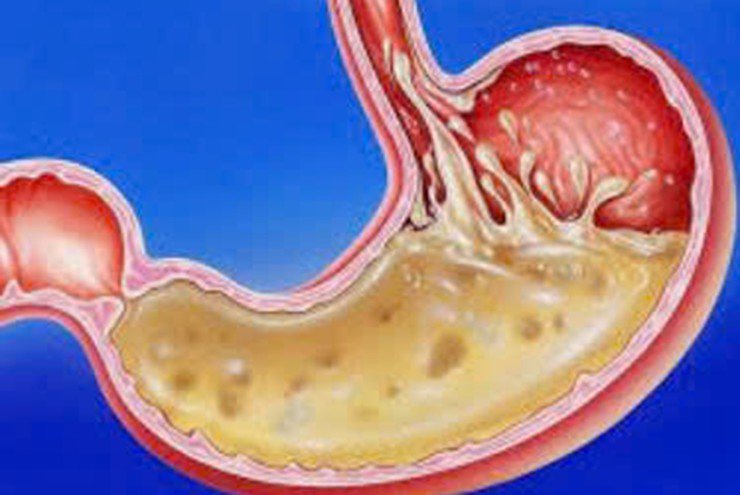 Trào ngược dạ dày gây viêm rát họng, nuốt nghẹn, đầy bụng: Đã tìm được giải pháp sau nhiều năm nghiên cứu