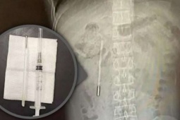 Nuốt nhiệt kế từ năm 12 tuổi, đau bụng mới biết dị vật vẫn còn nguyên sau 20 năm