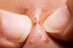 Tin tức sức khỏe - Hóa ra đây là cách xử lý mụn viêm của con trai: Không cần phải bôi kem mụn như con gái