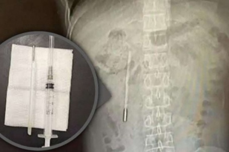 Nuốt nhiệt kế từ năm 12 tuổi, đau bụng mới biết dị vật vẫn còn nguyên sau 20 năm