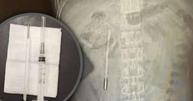 Nuốt nhiệt kế từ năm 12 tuổi, đau bụng mới biết dị vật vẫn còn nguyên sau 20 năm