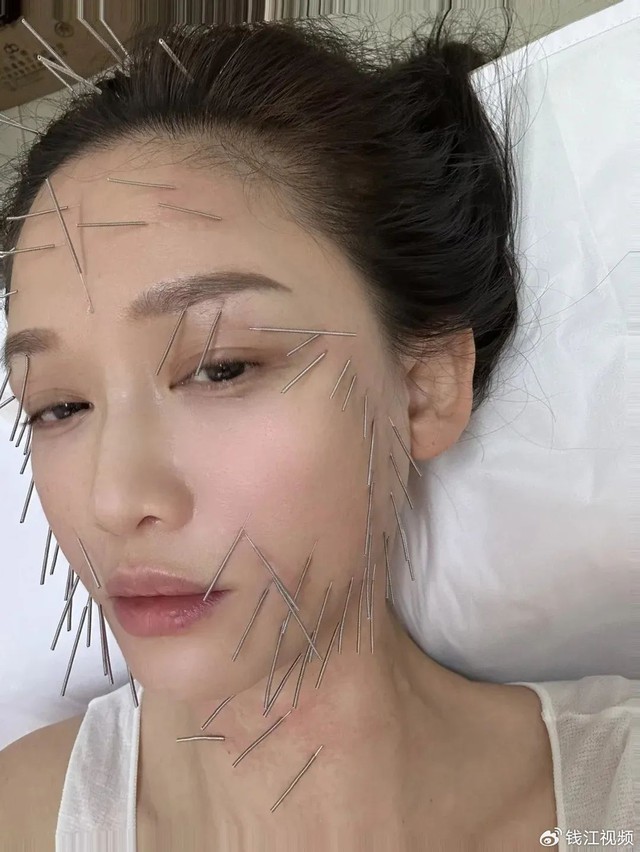 Diễn viên Trần Kiều Ân cũng áp dụng châm cứu để giảm béo, cải thiện gương mặt thanh thoát, thon gọn.