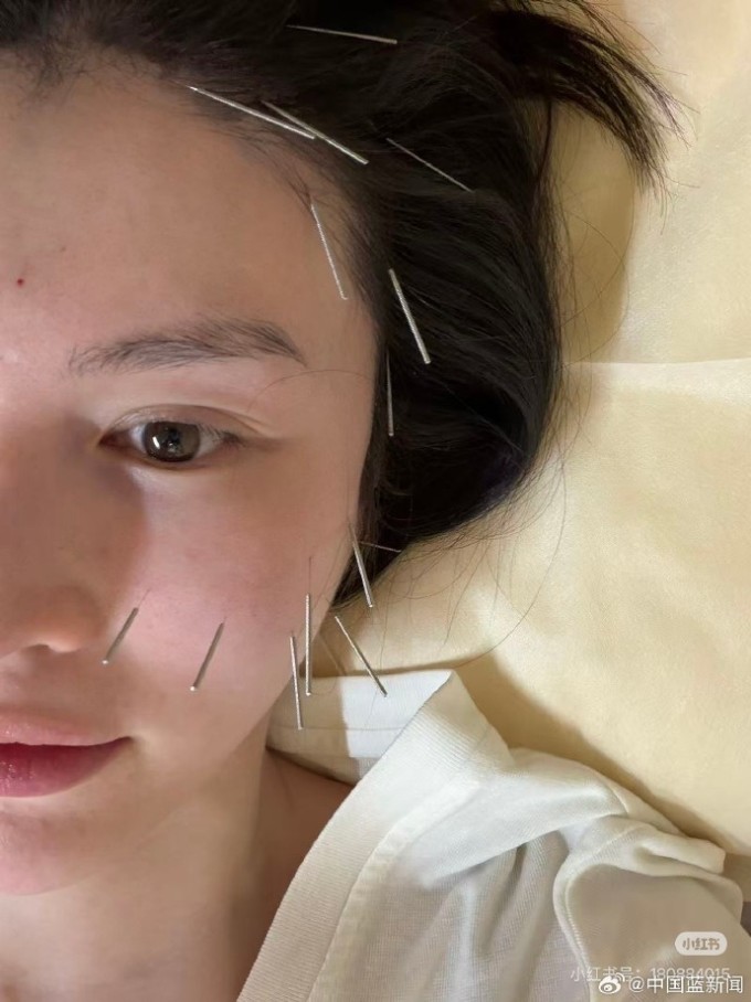 Hà Tuệ gần đây áp dụng châm cứu để cải thiện độ săn chắc, nâng cơ mặt.