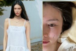 Bạn gái Trần Vỹ Đình châm cứu để nâng cơ, ngừa chảy xệ da