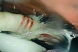 Người đàn ông nuốt cùng lúc 3 bàn chải đánh răng vào bụng