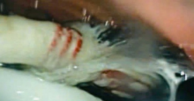 Người đàn ông nuốt cùng lúc 3 bàn chải đánh răng vào bụng