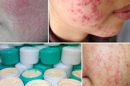 Sau Hydroquinone, người dùng nên kỳ vọng gì ở một sản phẩm làm sáng da lành tính?