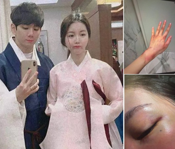 Anh trai Jisoo bên vợ ngày cưới (trái) và những vết thương người vợ chịu đựng (phải). Ảnh: Nate