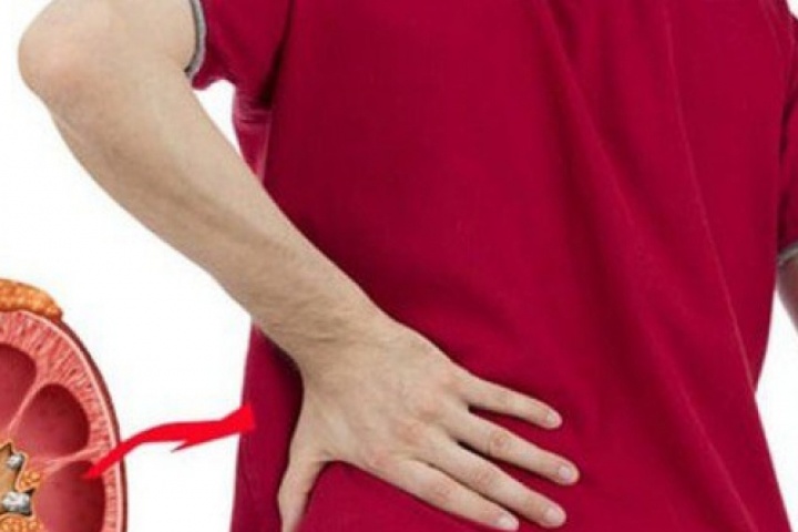 Sỏi thận có gây rối loạn cương dương?