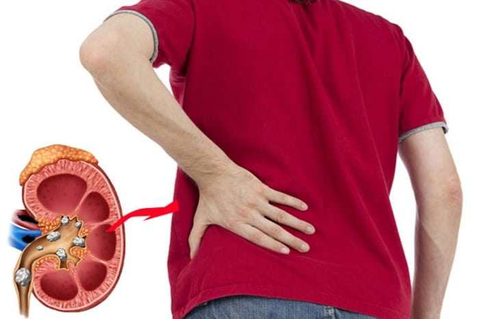 Sỏi thận không phải là nguyên nhân trực tiếp gây rối loạn cương dương, nhưng có thể tác động gián tiếp thông qua nhiều cơ chế khác nhau.