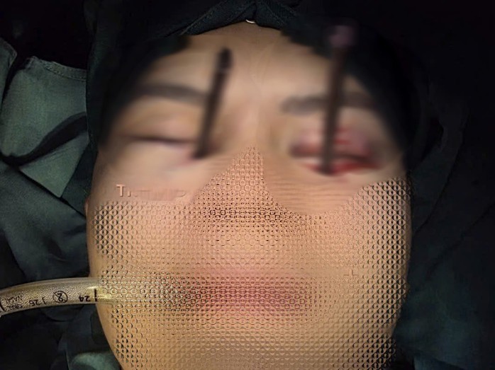 Dị vật là 2 chiếc đũa đâm sâu vào hốc mắt. Ảnh: Bệnh viện cung cấp