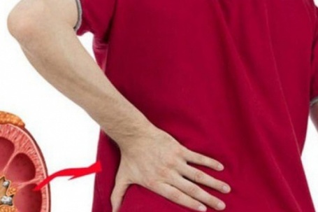 Sỏi thận có gây rối loạn cương dương?