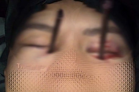 Cứu nam thanh niên bị 2 chiếc đũa đâm sâu vào 2 hốc mắt